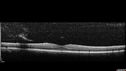 pdr_fovealhypoplasia_joaus_021720_05.jpg