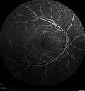 pdr_fovealhypoplasia_joaus_021720_09.jpg