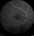 pdr_fovealhypoplasia_joaus_021720_10.jpg