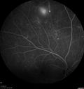 pdr_fovealhypoplasia_joaus_021720_11.jpg