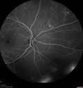 pdr_fovealhypoplasia_joaus_021720_12.jpg