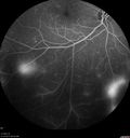 pdr_fovealhypoplasia_joaus_021720_13.jpg