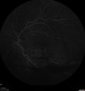 pdr_fovealhypoplasia_joaus_021720_16.jpg