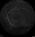 pdr_fovealhypoplasia_joaus_021720_17.jpg