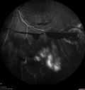 pdr_fovealhypoplasia_joaus_021720_21.jpg