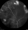 pdr_fovealhypoplasia_joaus_021720_23.jpg