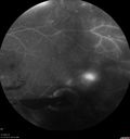 pdr_fovealhypoplasia_joaus_021720_26.jpg