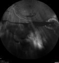 pdr_fovealhypoplasia_joaus_021720_29.jpg
