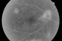 pdrfibrosis_jesh_281229.png