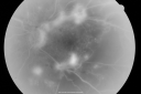 pdrfibrosis_jesh_281429.png