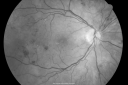 pdrfibrosis_jesh_28529.png