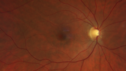 plaquenil_4yr_chfra_111819_01.png