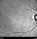 plaquenil_4yr_chfra_111819_05.jpg