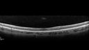 plaquenil_4yr_chfra_111819_11.jpg