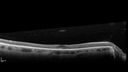 plaquenil_4yr_chfra_111819_12.jpg