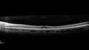plaquenil_4yr_chfra_111819_14.jpg
