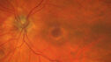plaquenil_elmcc1_052421_02.jpg