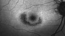 plaquenil_elmcc1_052421_03.jpg
