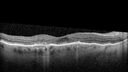plaquenil_elmcc1_052421_07.jpg