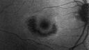 plaquenil_elmcc2_020322_11.jpg