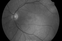 plaqueniltox_locl09.png
