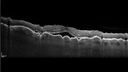 posteriorScleritis_jemcm1_040119_06.jpg