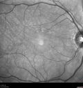 posteriorScleritis_jemcm1_040119_07.jpg
