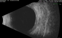 posteriorScleritis_jemcm1_040119_30.png