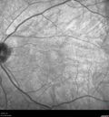 posteriorScleritis_jemcm2_050219_poaststeroids_01.jpg