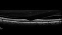 posteriorScleritis_jemcm2_050219_poaststeroids_03.jpg