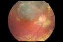 radiationretinopathy_brda02.png