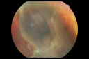 radiationretinopathy_brda03.png