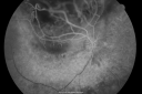 radiationretinopathy_brda09.png
