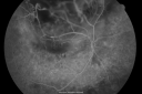 radiationretinopathy_brda12.png
