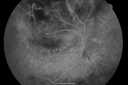 radiationretinopathy_brda13.png
