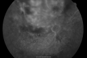 radiationretinopathy_brda17.png