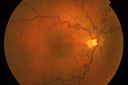 retinalvasctortuosity_28129.jpg