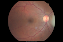 retinocytoma01.png