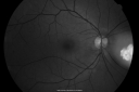 retinocytoma06.png