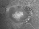retinocytoma17.png
