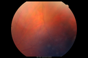 retinoschisis_dasi03.png