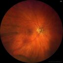 retinoschisis_jaber_101220_01.jpg