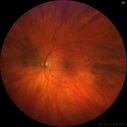 retinoschisis_jaber_101220_04.jpg