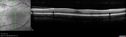 rop-foveal-od-kaba_000000.jpg