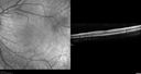 rop-foveal-os-kaba_002000.jpg