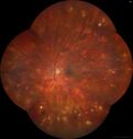 sarcoid-Multifocal-Choroiditis_jamil_01.jpg