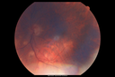 sarcoid_jamil_021216_06.png