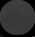 sarcoid_jamil_021216_18.jpg