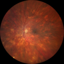 sarcoid_jamil_081519_28229.png