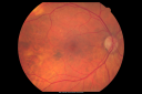 sclerochoroidalcalcificationpali_28329.png